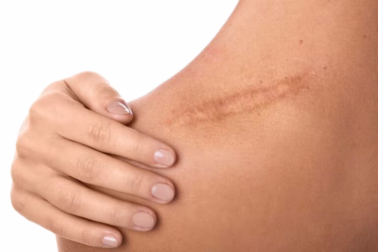 Comment la lumière rouge accélère-t-elle la réparation cutanée ?