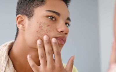 Acné chez les adolescents : causes, conséquences sociales et solutions avec la luminothérapie