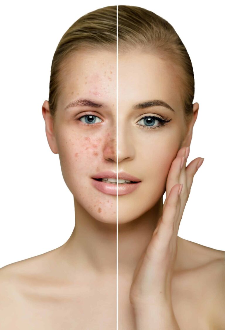 Pourquoi la lumière bleue est l'alliée de votre peau contre l'acnée ?