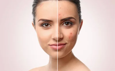 Acné rebelle : comment la LED bleue éradique 80 % des boutons en 4 semaines – preuves cliniques et méthodes